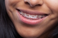 Porady higieny ustnej dla użytkowników aparatu ortodontycznego